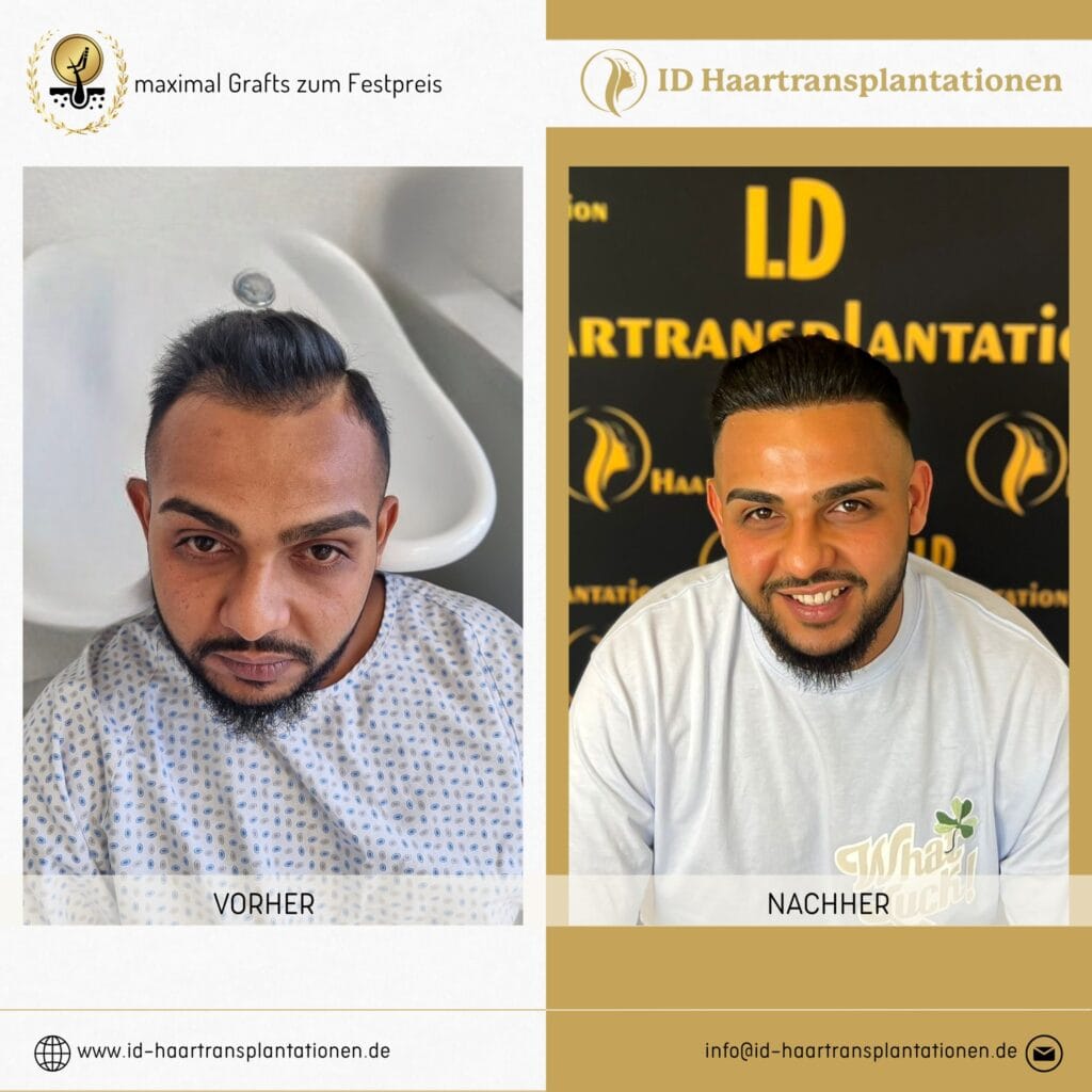 Haartransplantation Mannheim – Ihr Weg zu gesundem und vollem Haar