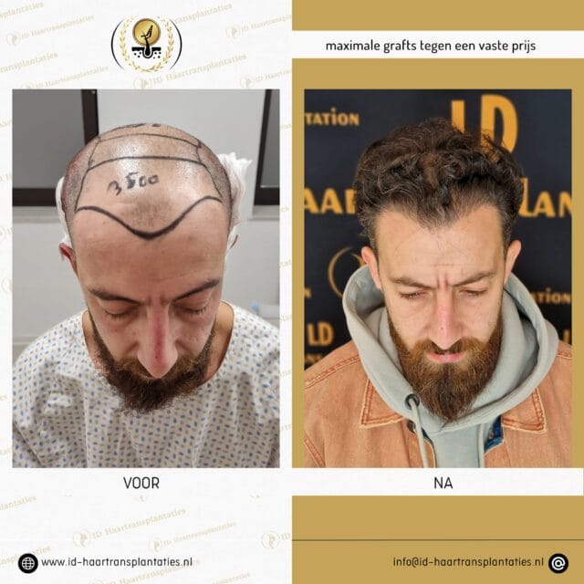 Haartransplantation Deutschland – Ihre Optionen für volles Haar