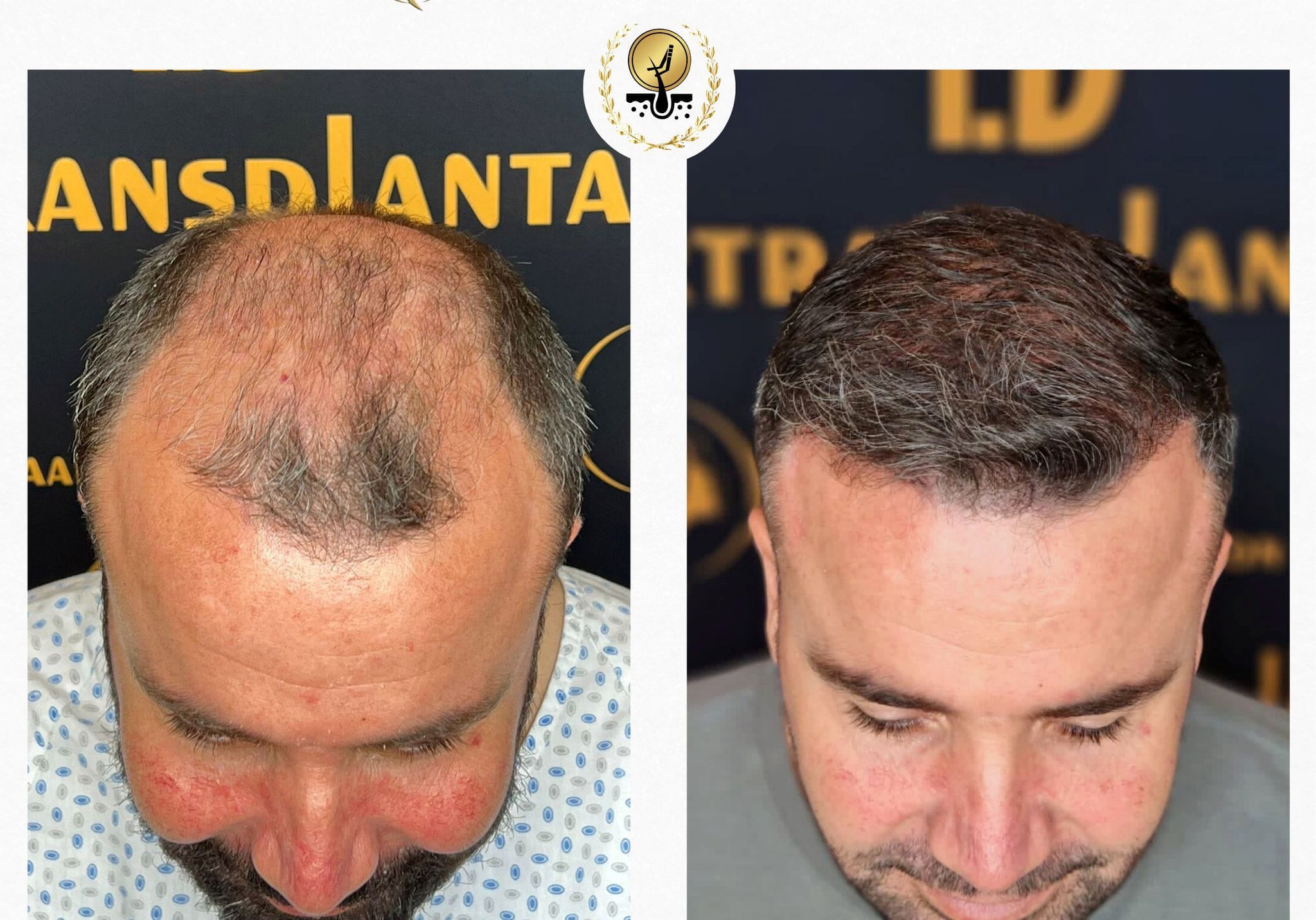 Wie viel kostet eine Haartransplantation in Mannheim?