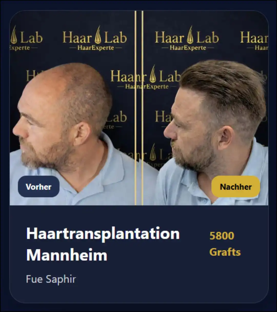 Haartransplantation Mannheim