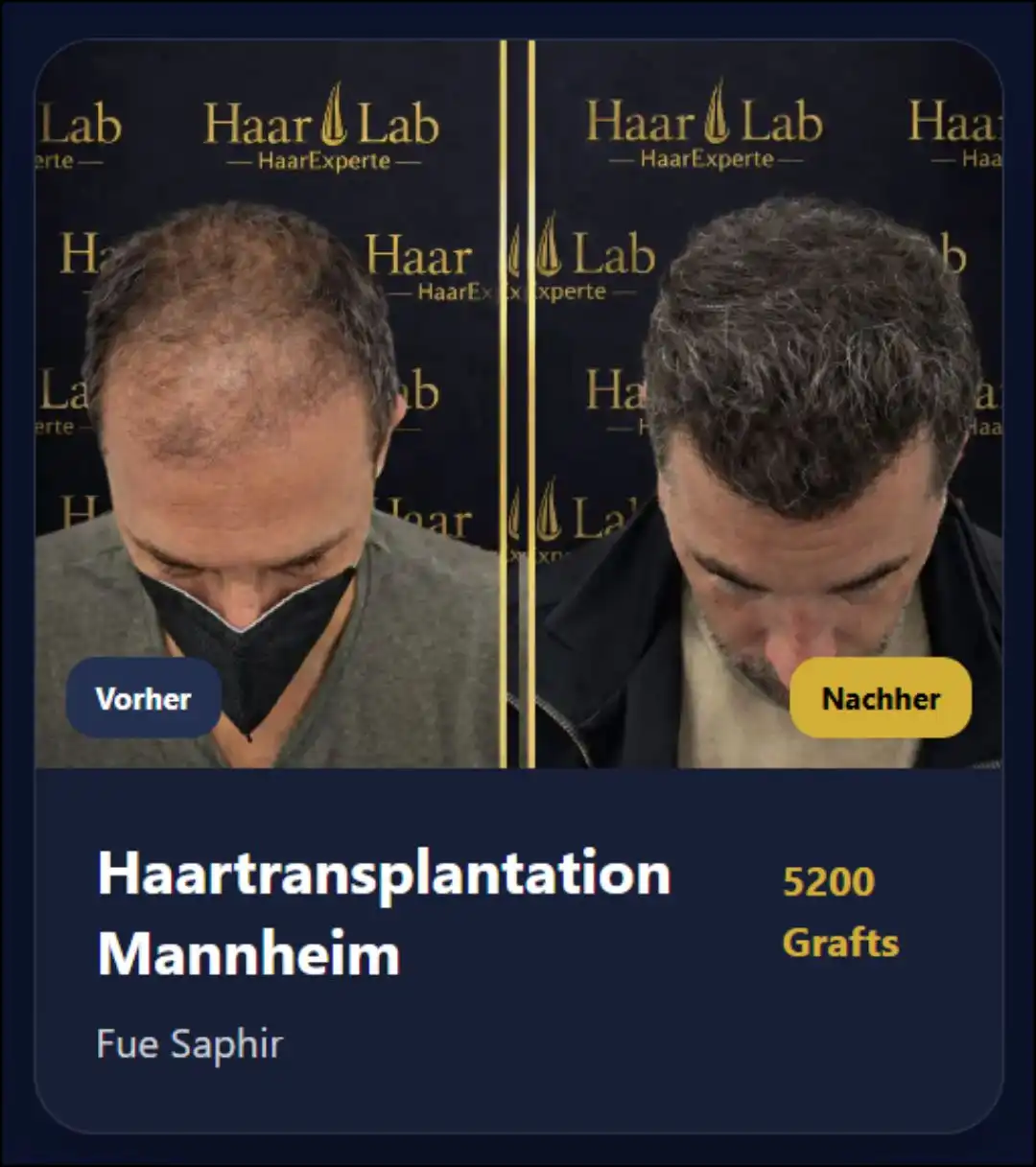 Haartransplantation Mannheim