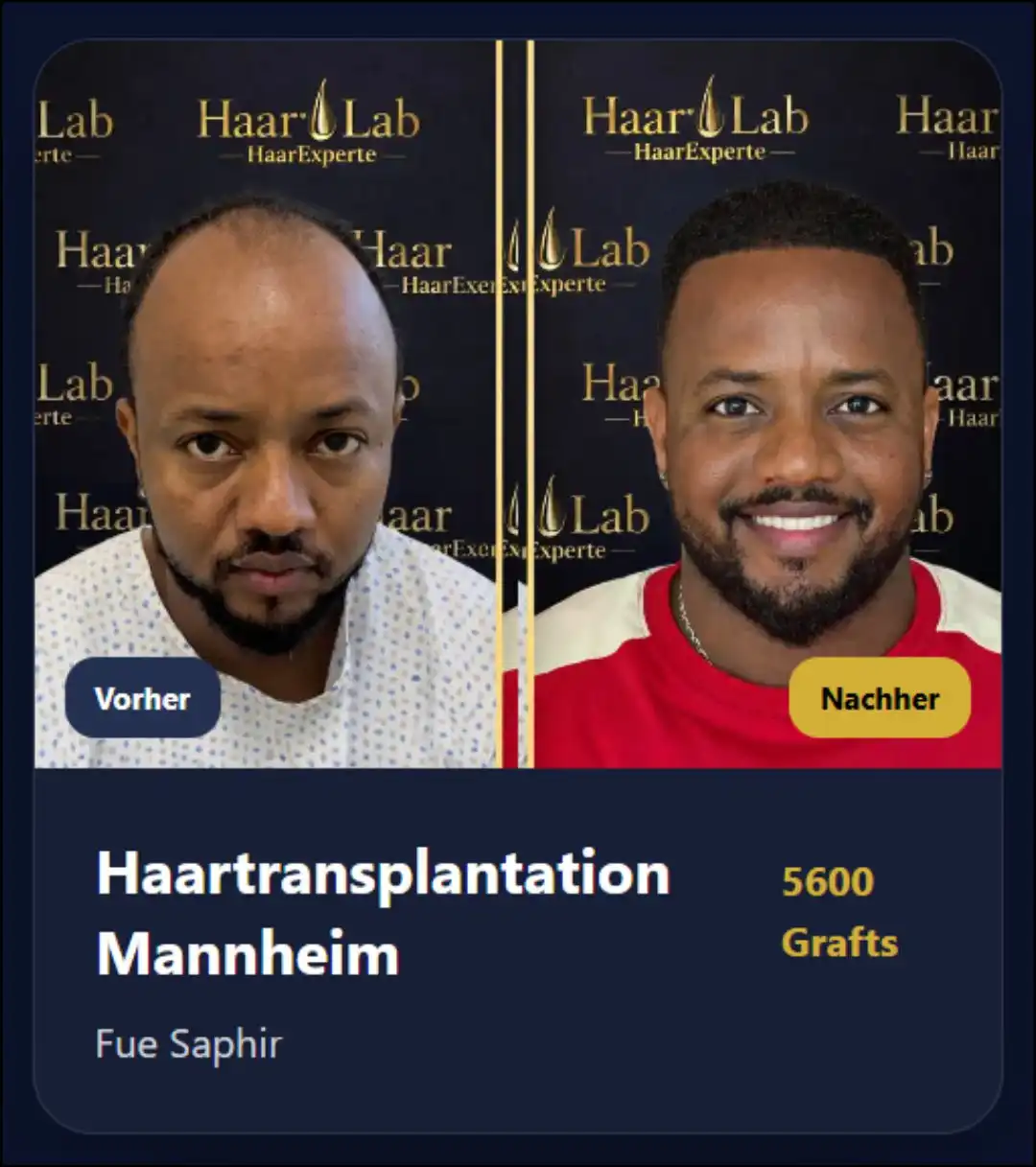 Haartransplantation Mannheim