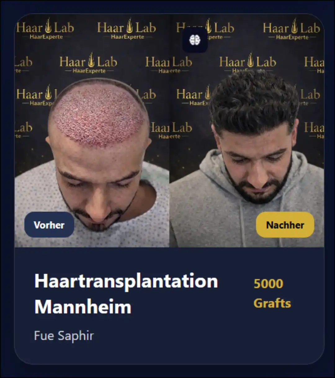 Haartransplantation Mannheim