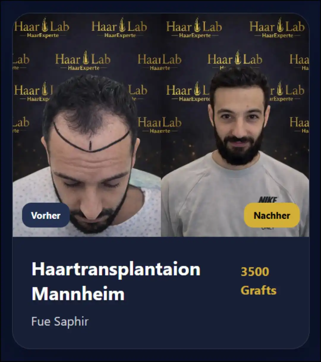 Haartransplantation Mannheim