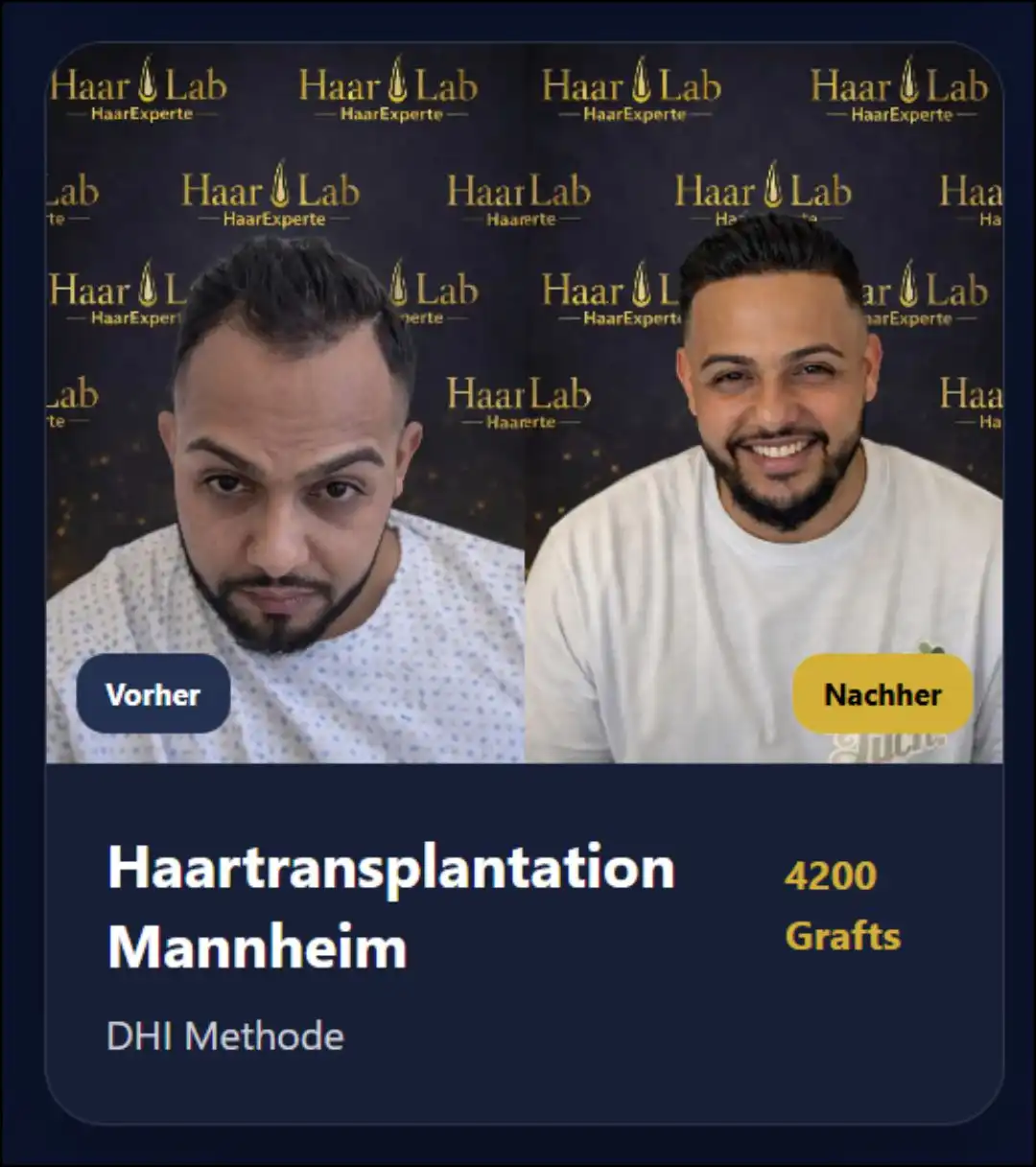 Haartransplantation Mannheim