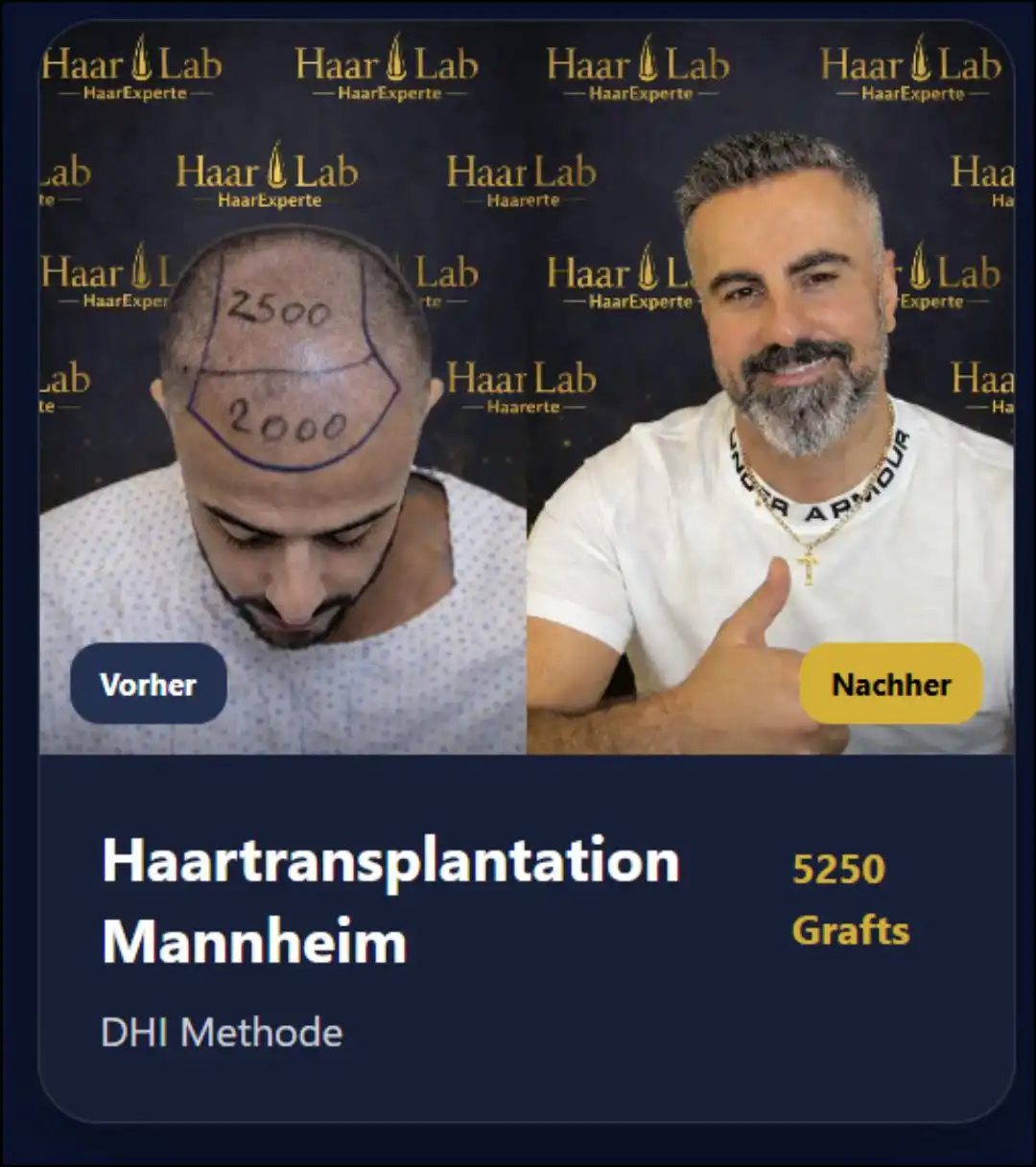 Haartransplantation Mannheim