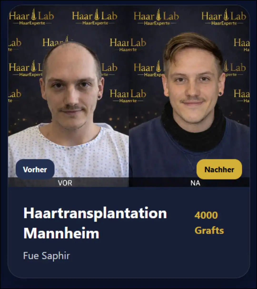 Haartransplantation Mannheim